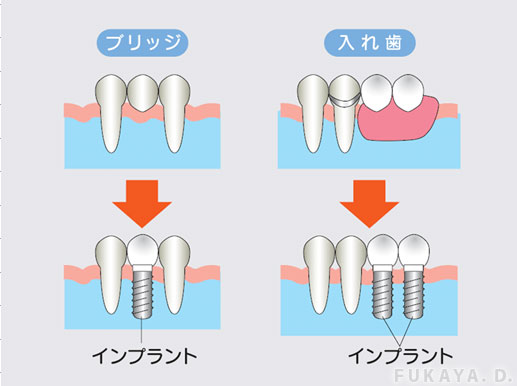（図）インプラントとブリッジ・入れ歯の違い